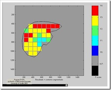 fibrotac-fibrosis-biopsia