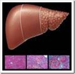 hepatitis-c-cirrosis-hepatica